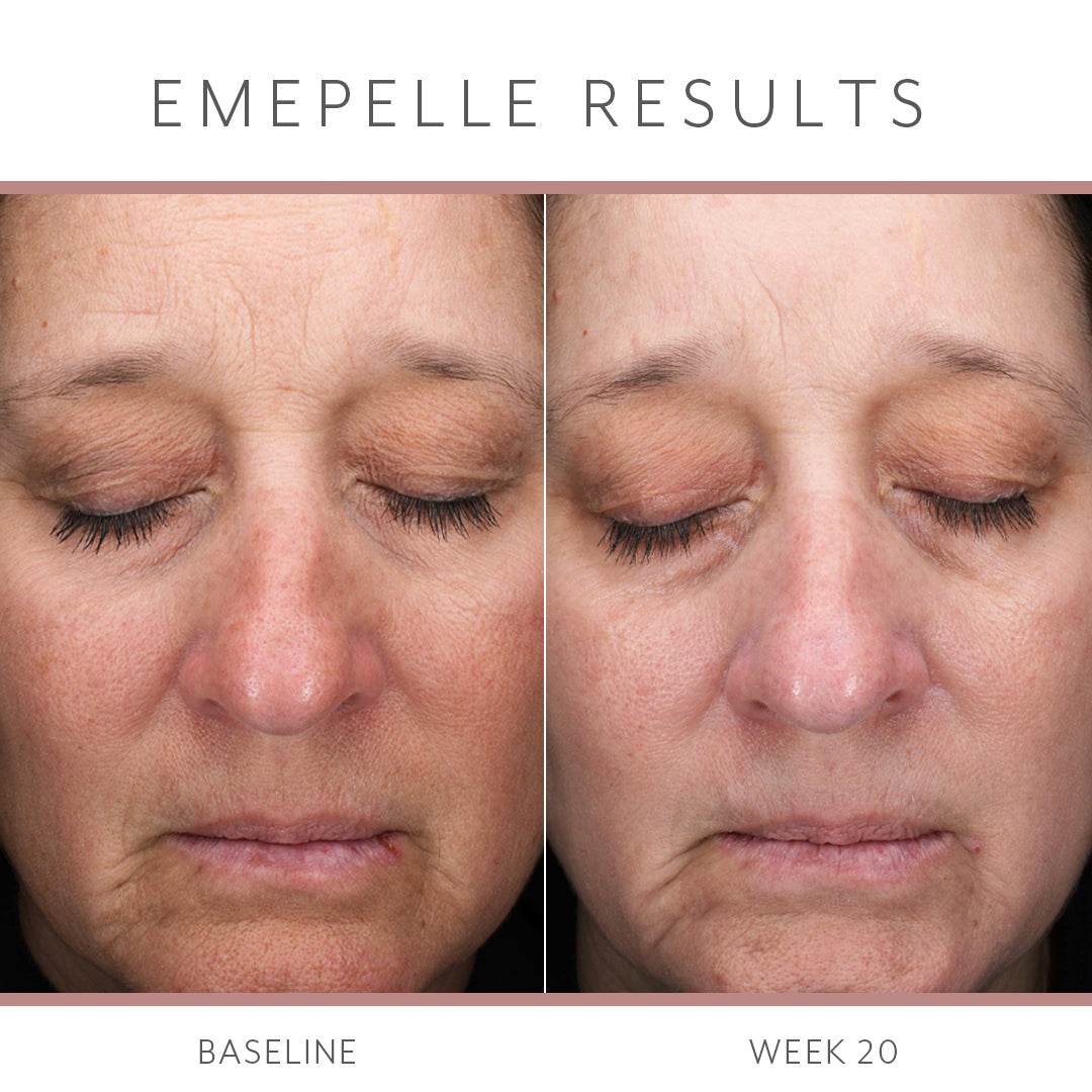 Emepelle Night Cream – 48g