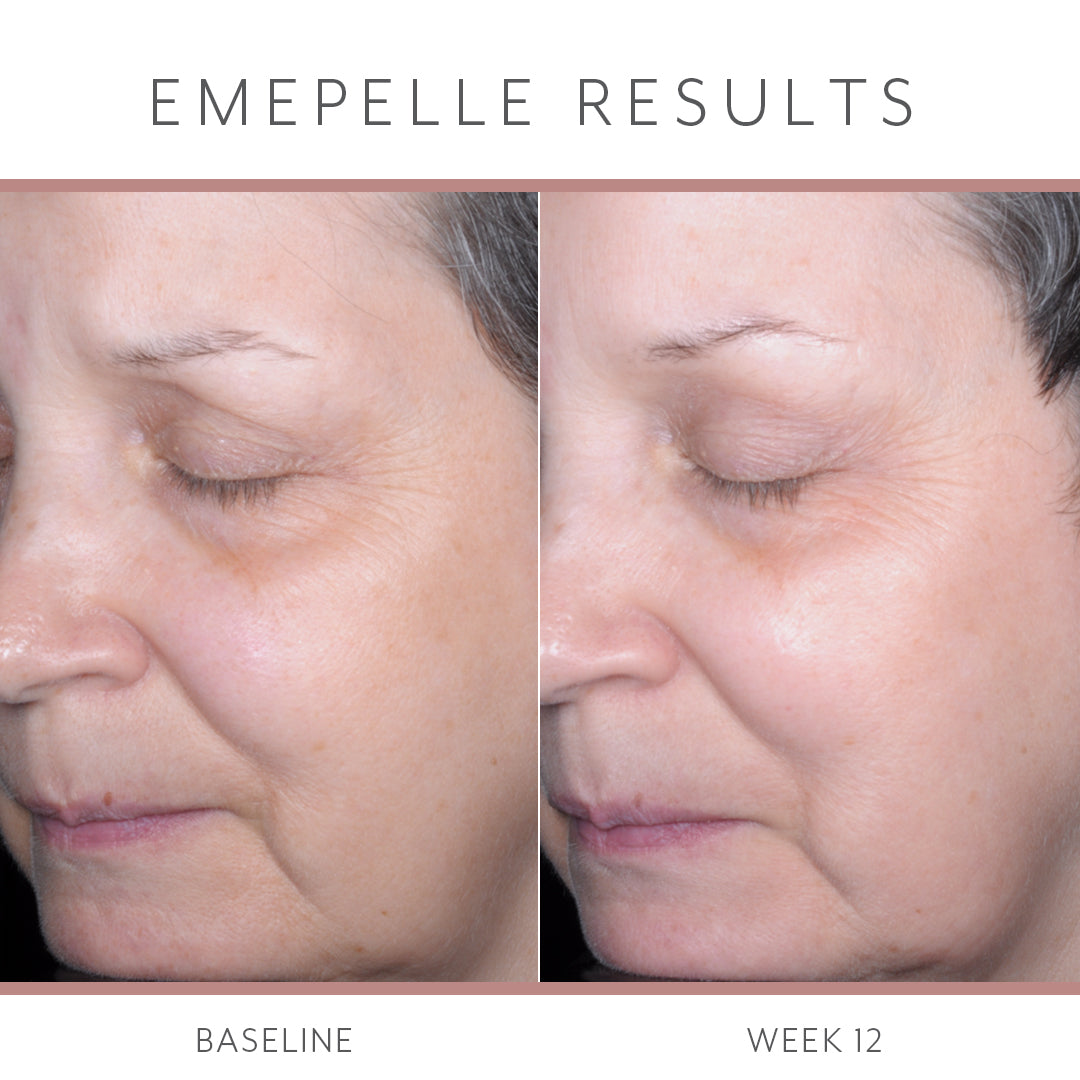 Emepelle Serum – 35mL