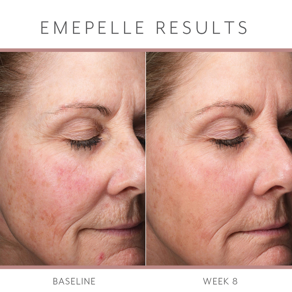 Emepelle Serum – 35mL