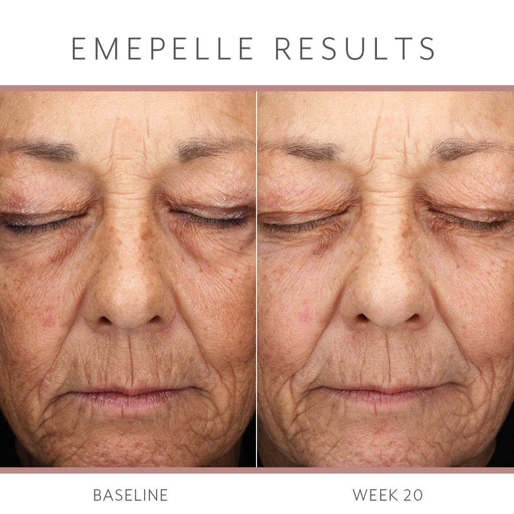 Emepelle Serum – 35mL