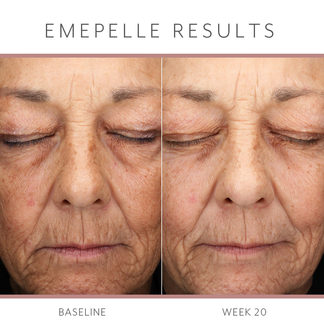 Emepelle Serum – 35mL